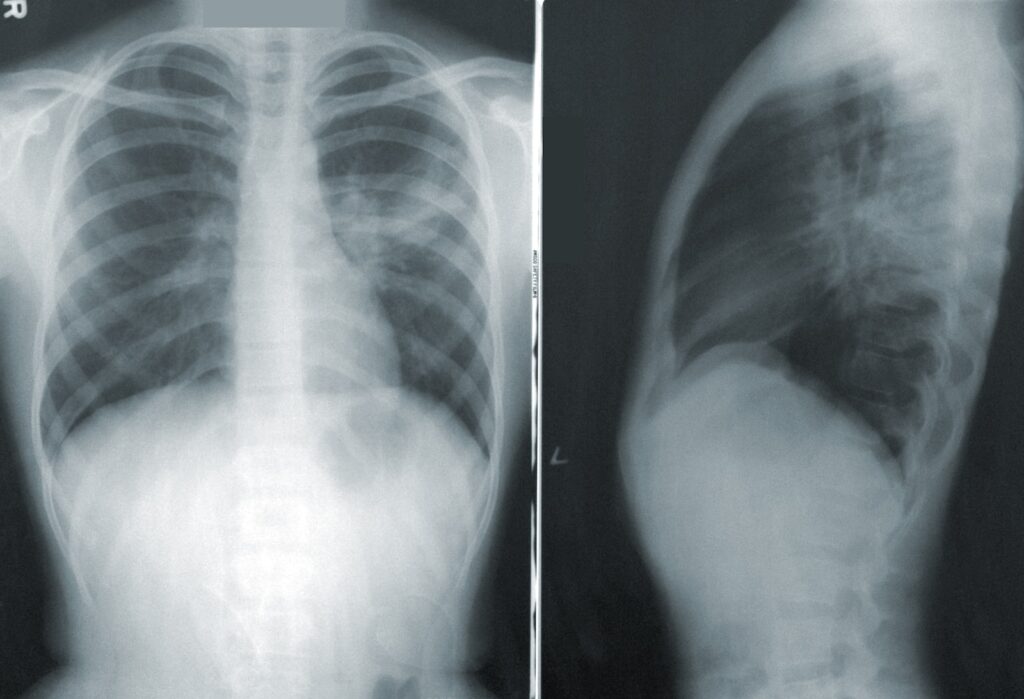Comment identifier une maladie pulmonaire ?