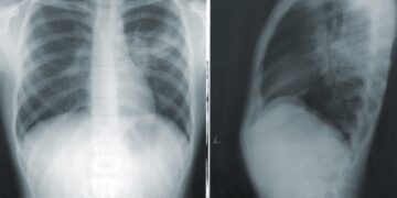 Comment identifier une maladie pulmonaire ?