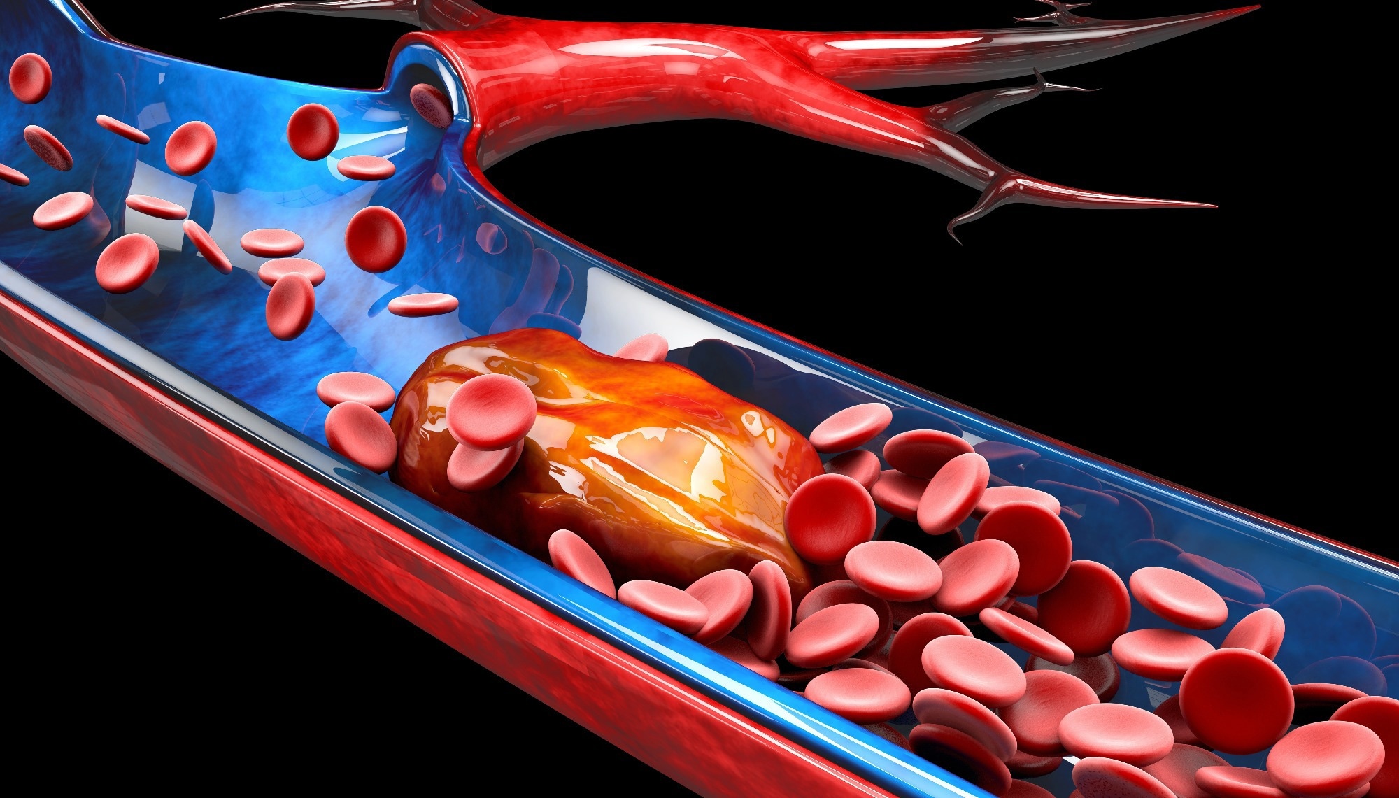 Study: Subtype-specific plasma signatures of platelet-related protein releasate in acute pulmonary embolism. Image Credit: Victor Josan/Shutterstock