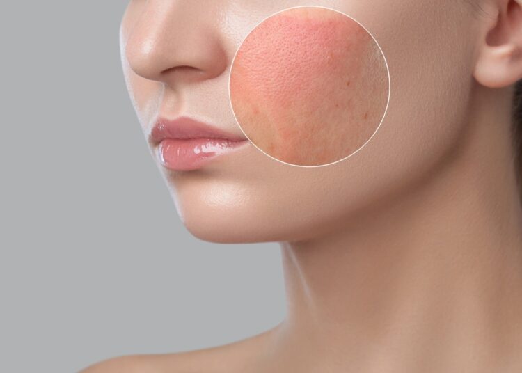 Study: Inflammation Causes Exacerbation of COVID-19: How about Skin Inflammation? Image Credit: dimid_86/Shutterstock