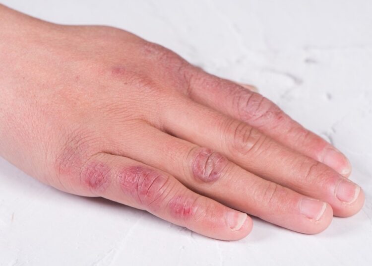 Study: COVID-toes: An ecological study of chilblains and COVID-19 diagnoses in Victoria, Australia. Image Credit: lungfu01 / Shutterstock.com
