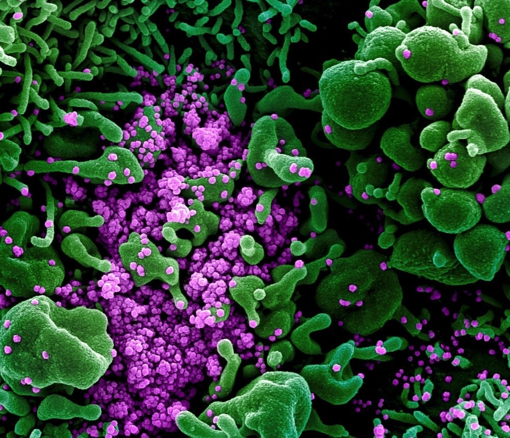BW.1- une nouvelle sous-variante d'Omicron qui échappe à l'immunité