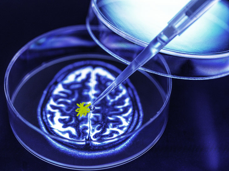 Maladie d'Alzheimer : un nouveau biomarqueur identifié pourrait conduire à un diagnostic plus précoce