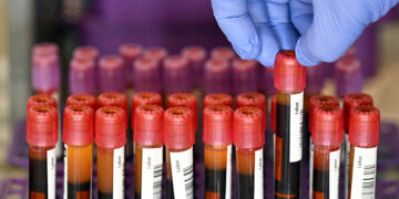 Alzheimer : un test sanguin peut détecter des années de protéines "toxiques" avant l'apparition des symptômes