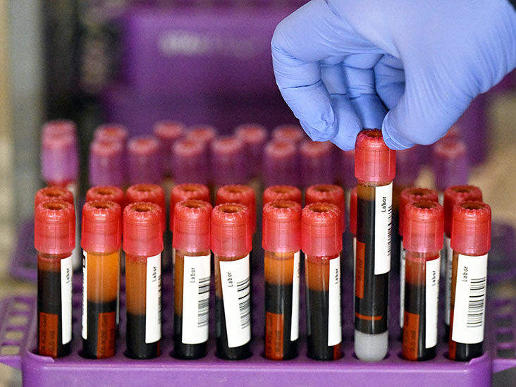 Alzheimer : un test sanguin peut détecter des années de protéines "toxiques" avant l'apparition des symptômes