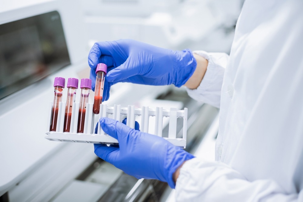 Study: Circulating adipokine levels and COVID-19 severity in hospitalized patients. Image Credit: Near D Krasaesom / Shutterstock.com