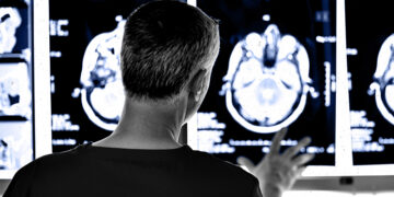 Lecanemab : pourquoi un nouveau médicament contre la maladie d'Alzheimer a suscité des éloges et des inquiétudes