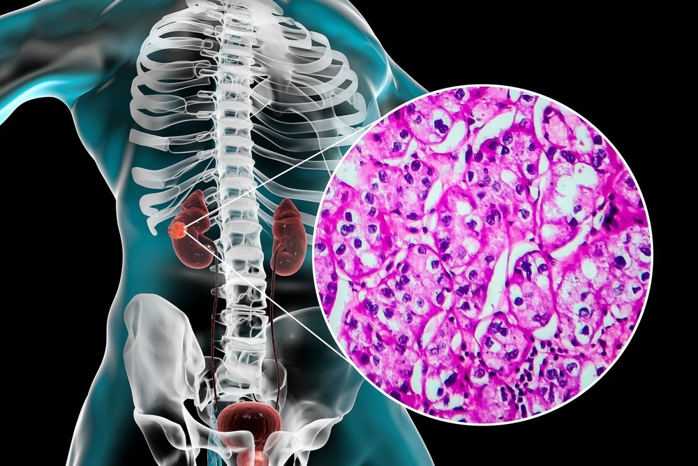 Prise de décision partagée dans le carcinome à cellules rénales (RCC)