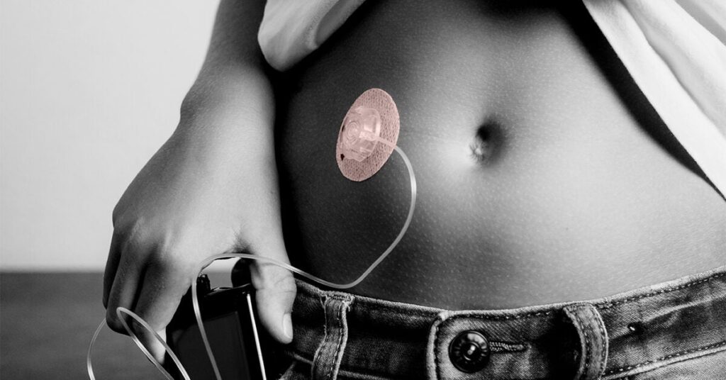 Diabète de type 2 : le pancréas artificiel pourrait bientôt être une option