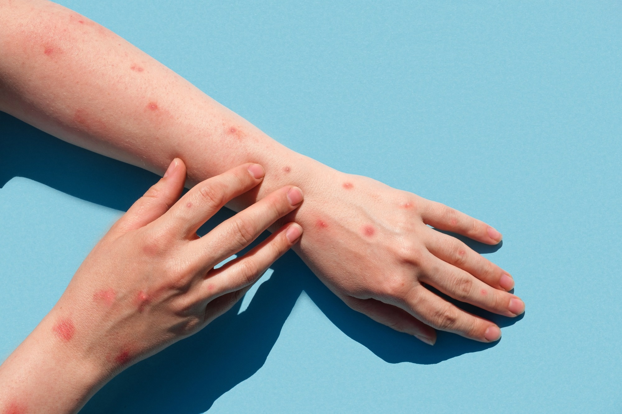 Study: Monkeypox Virus Evolution before 2022 Outbreak. Image Credit: Marina Demidiuk/Shutterstock