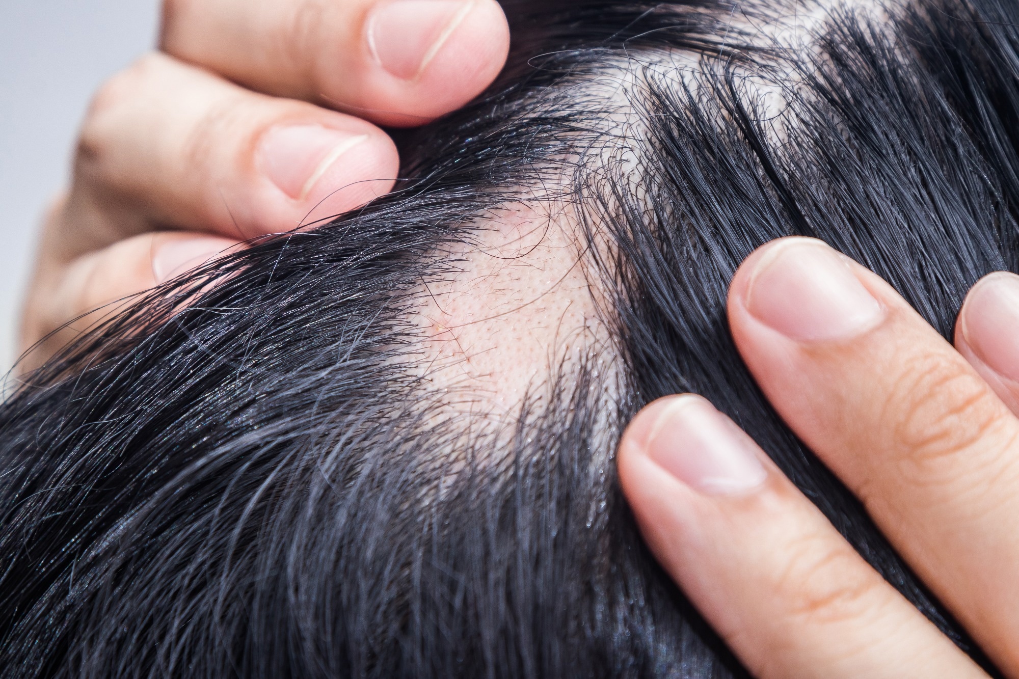 Study: The Association between Sugar-Sweetened Beverages and Male Pattern Hair Loss in Young Men. Image Credit: Landscapemania / Shutterstock