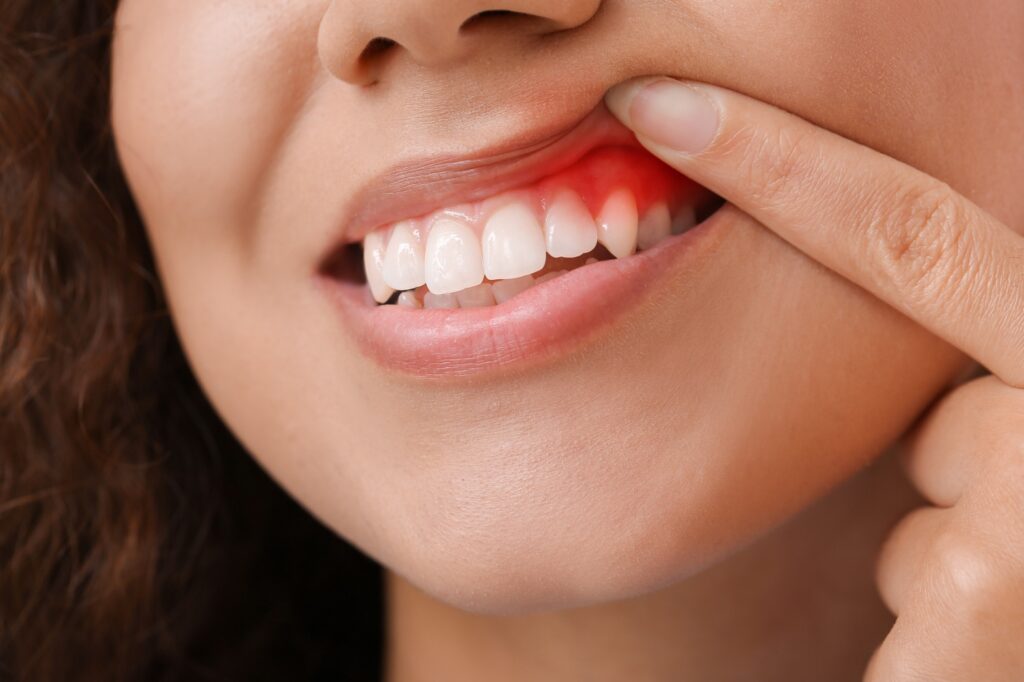 Comment traiter une gingivite ?