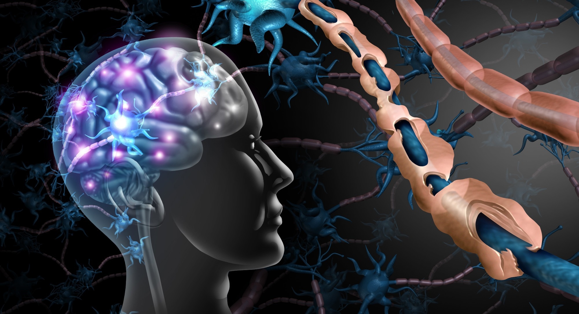 Study: Occurrence and Severity of Coronavirus Disease 2019 Are Associated With Clinical Disability Worsening in Patients With Multiple Sclerosis. Image Credit: Lightspring/Shutterstock