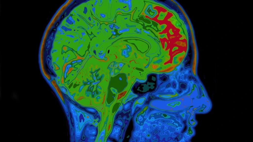 Brain cells may age faster in people with cocaine use disorder