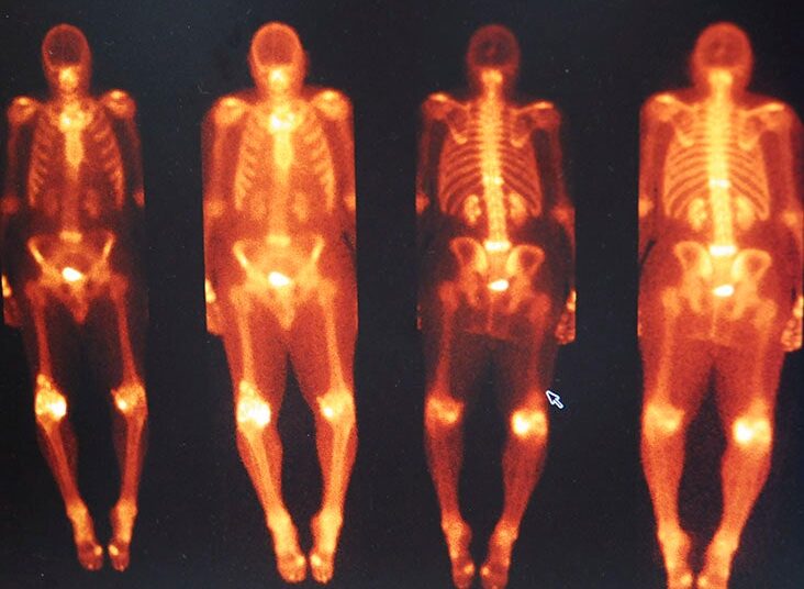 Quelle est la fréquence de l'amylose cardiaque?  Une étude sur la scintigraphie osseuse examine la prévalence et l'impact