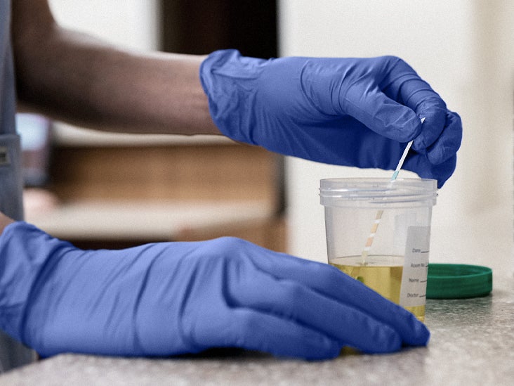 Cancer de la vessie : un nouveau test peut aider à prédire la maladie des années avant les symptômes