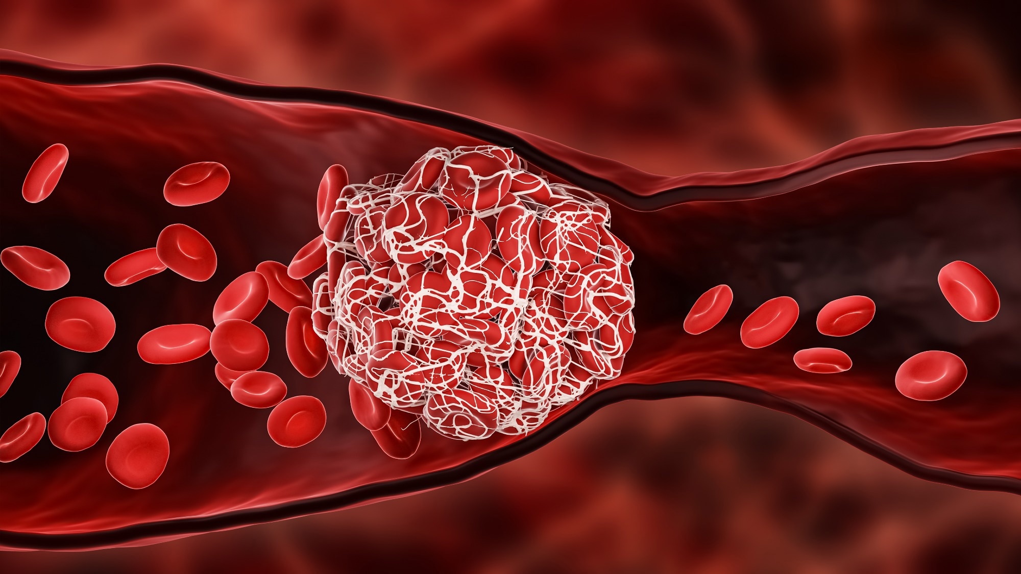 Assessment of the Risk of Venous Thromboembolism in Nonhospitalized Patients With COVID-19