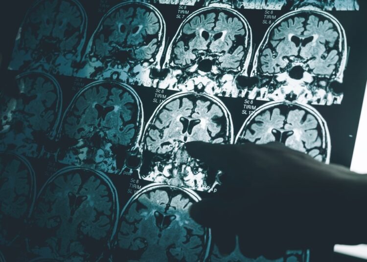 Study: Alzheimer’s disease: insights and new prospects in disease pathophysiology, biomarkers and disease-modifying drugs. Image Credit: Atthapon Raksthaput/Shutterstock