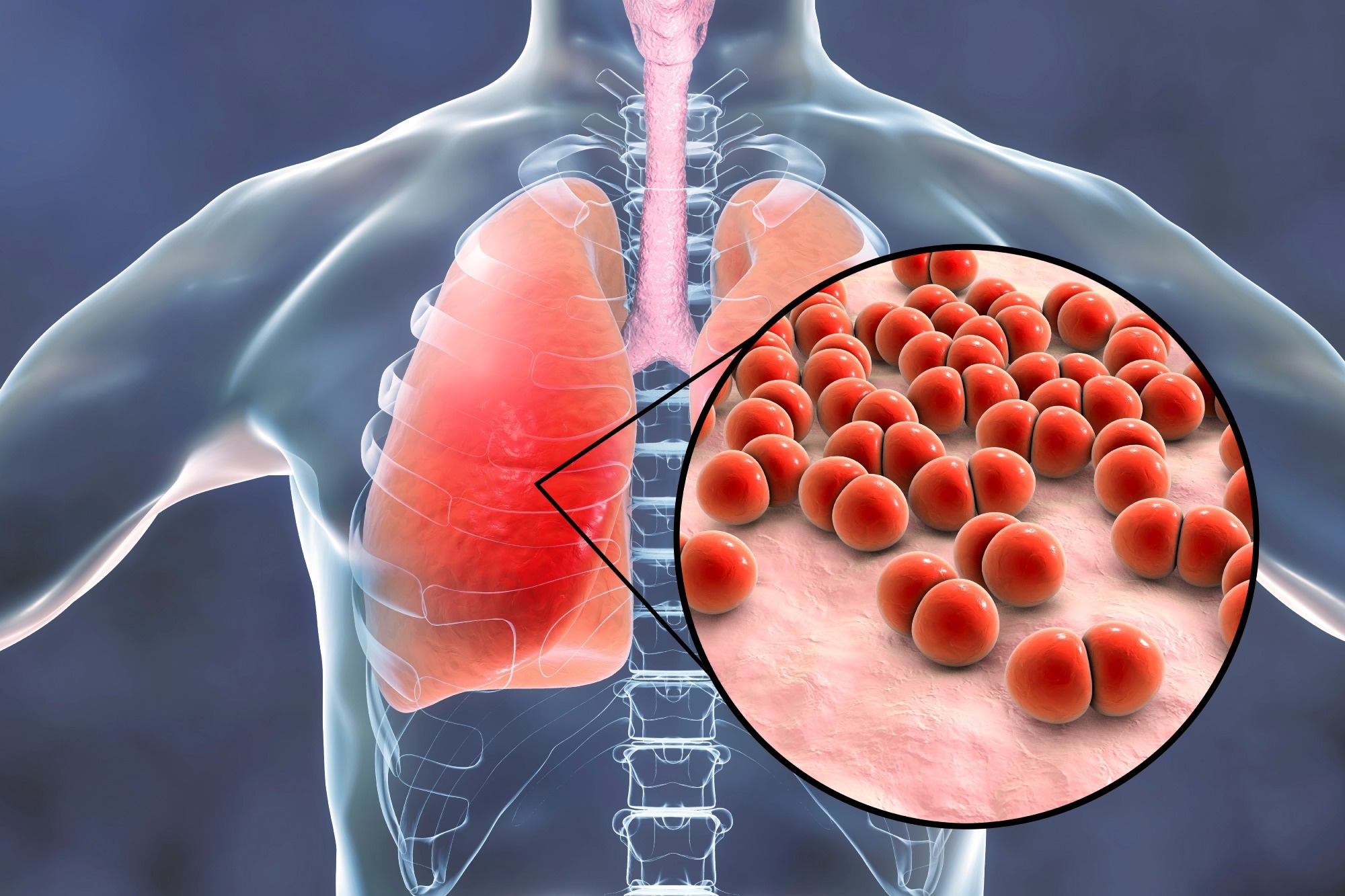 Study: Risk of Acute Myocardial Infarction Among Patients With Laboratory-Confirmed Invasive Pneumococcal Disease: A Self-Controlled Case Series Study. Image Credit: Kateryna Kon / Shutterstock