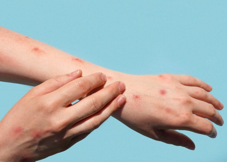 Study: T helper 1 effector memory CD4+ T cells protect the skin from poxvirus infection. Image Credit: MarinaDemidiuk/Shutterstock.com