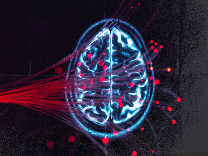 Schizophrénie : comment la croissance des vaisseaux sanguins dans le cerveau peut être un facteur
