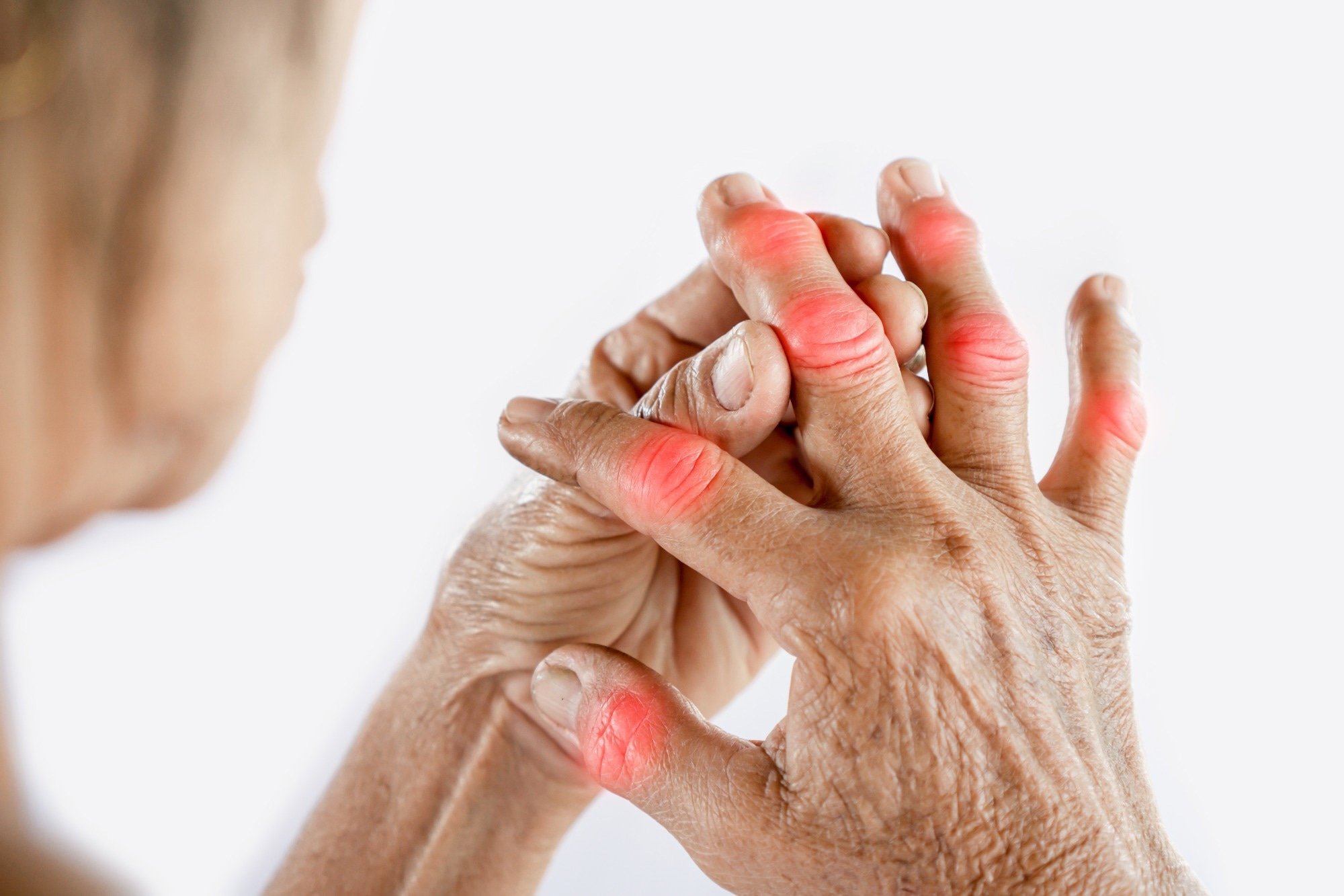 Study: Hmong microbiome ANd Gout, Obesity, Vitamin C (HMANGO-C): A phase II clinical study protocol. Image Credit: Doucefleur / Shutterstock