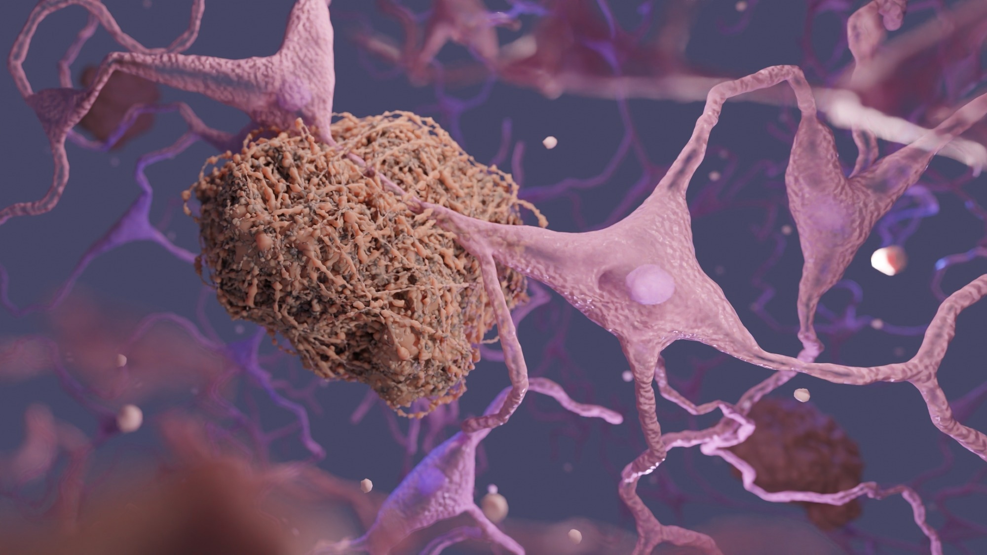 Une étude laisse entrevoir le potentiel des somnifères pour ralentir ou arrêter la progression de la maladie d'Alzheimer