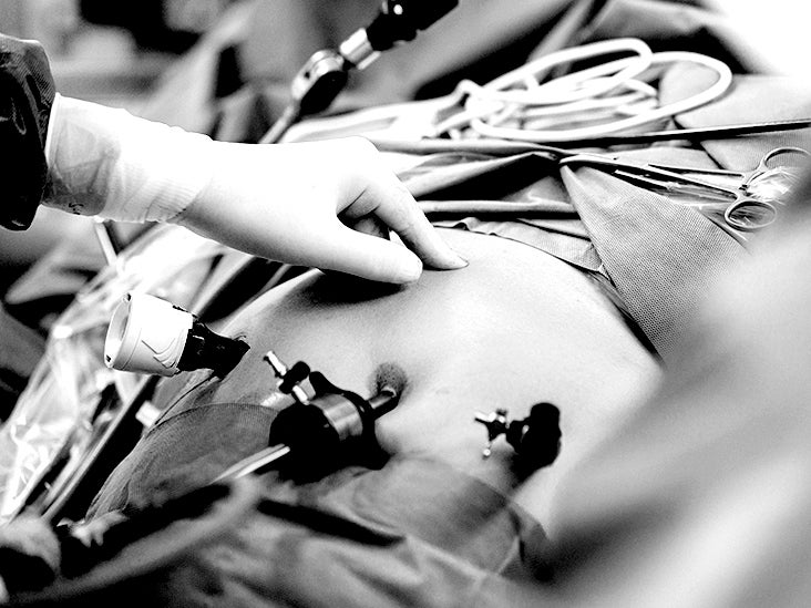 La chirurgie bariatrique pourrait réduire de plus de moitié le risque de cancers liés à l'obésité