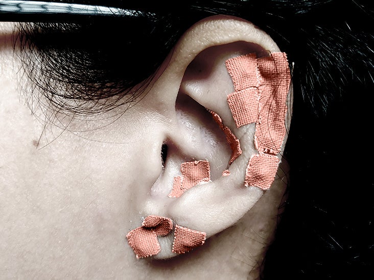 L'acupuncture auriculaire avec des perles peut favoriser la perte de poids