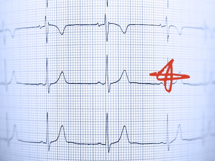 Les femmes sont plus de deux fois plus susceptibles que les hommes de mourir après une crise cardiaque, selon une étude