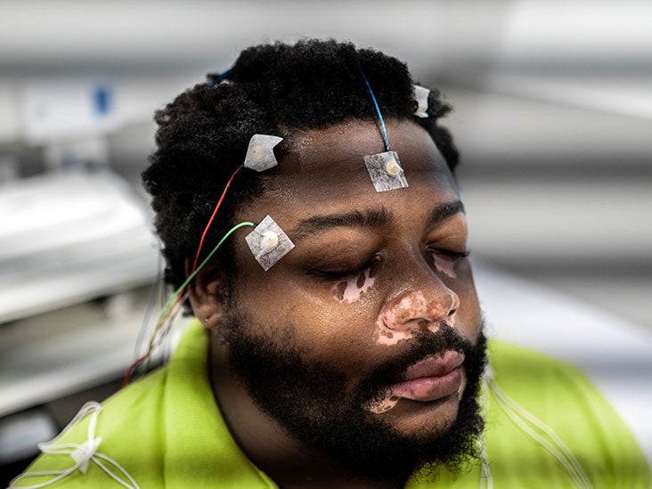 Les premiers signes de la maladie de Parkinson trouvés dans le microbiome intestinal des patients souffrant de troubles du sommeil
