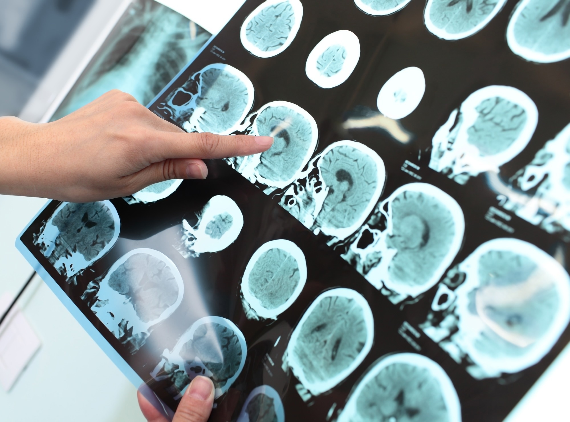 Study: Astrocyte reactivity influences amyloid-β effects on tau pathology in preclinical Alzheimer’s disease. Image Credit: sfam_photo/Shutterstock.com