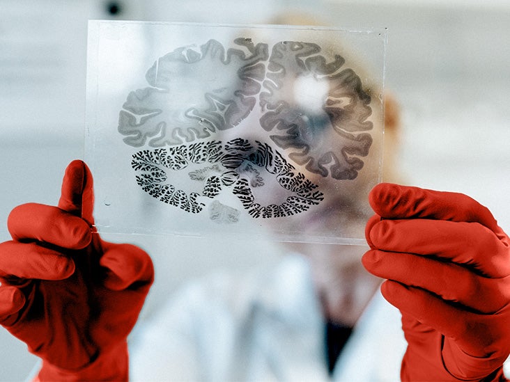 Une étude identifie comment la protéine tau toxique se propage dans le cerveau dans la maladie d'Alzheimer