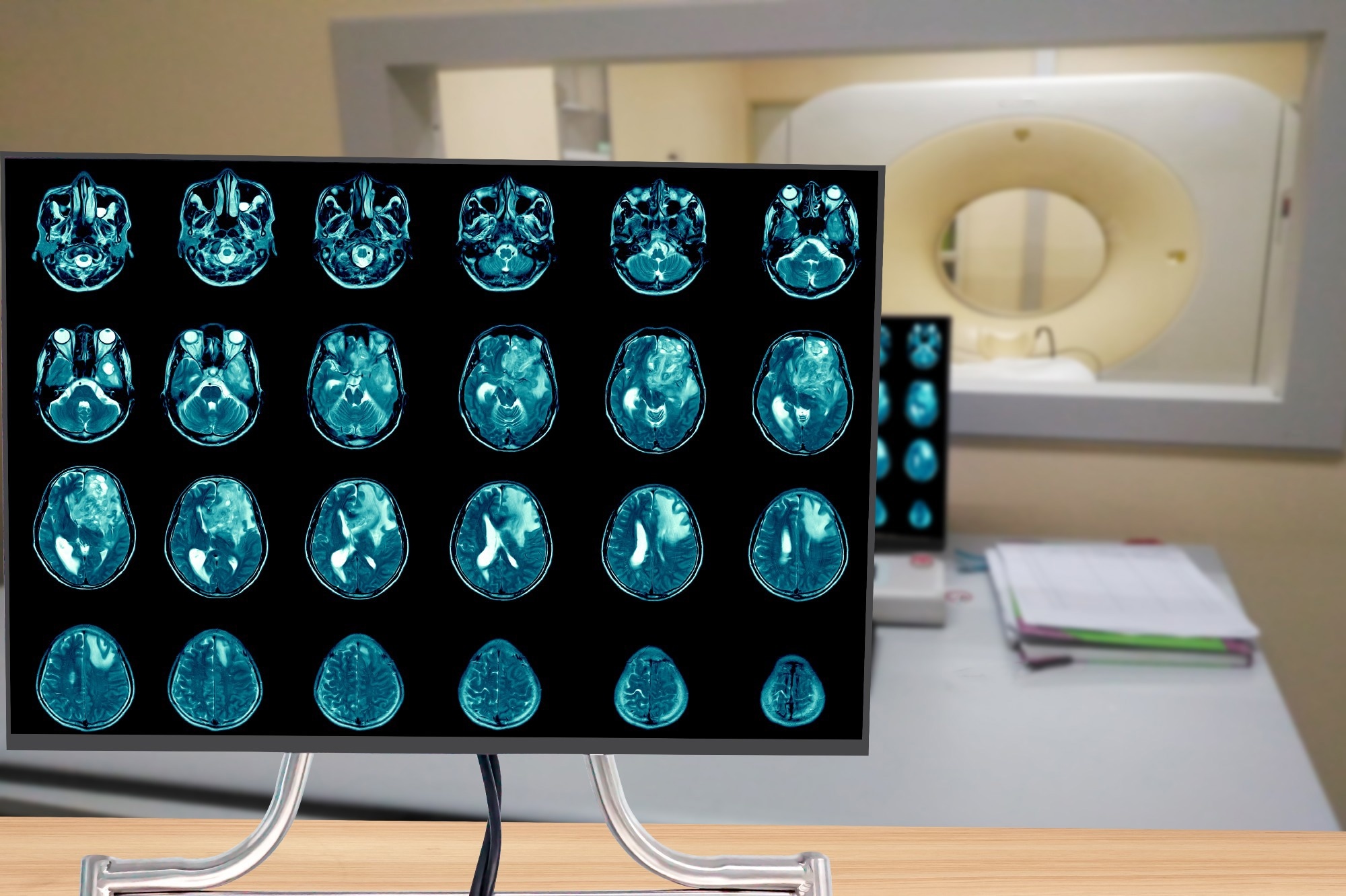 Study: Glioblastoma remodelling of human neural circuits decreases survival. Image Credit: Aprilstock/Shutterstock.com