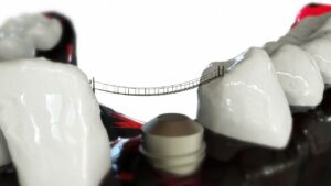 Implant dentaire : la solution durable pour retrouver un sourire éclatant