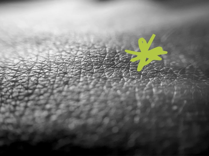 Comment les bactéries peuvent coloniser la peau et accélérer la croissance de l'eczéma