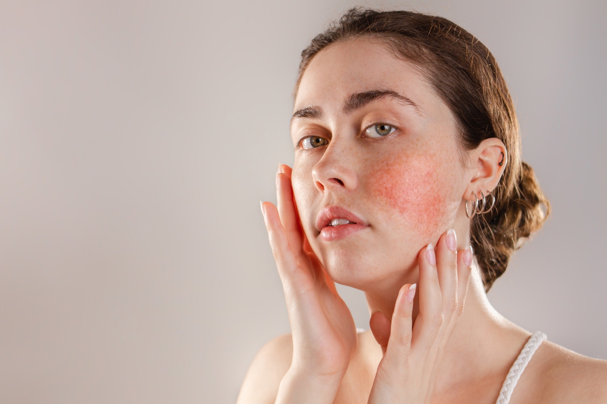 La génétique de l'inflammation neurogène dans la rosacée