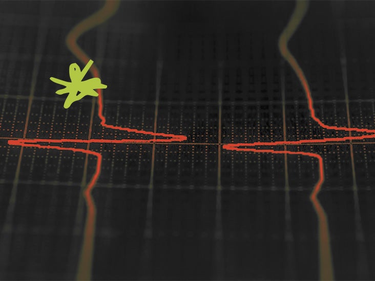 Le ciblage des macrophages inflammatoires peut aider à traiter et à prévenir l'AFib