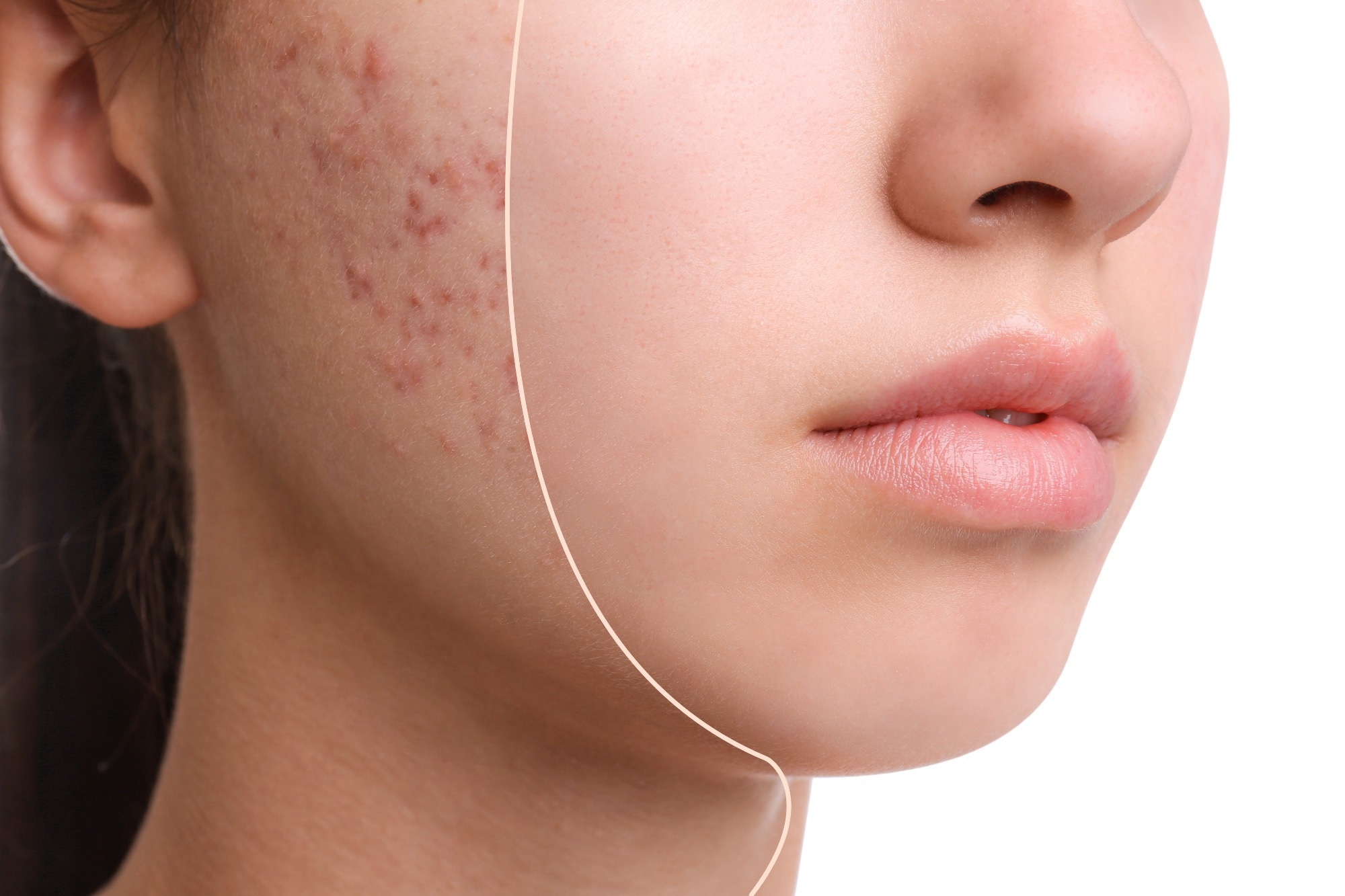 Study: Efficacy of FRO on Acne Vulgaris Pathogenesis. Image Credit: New Africa / Shutterstock.com