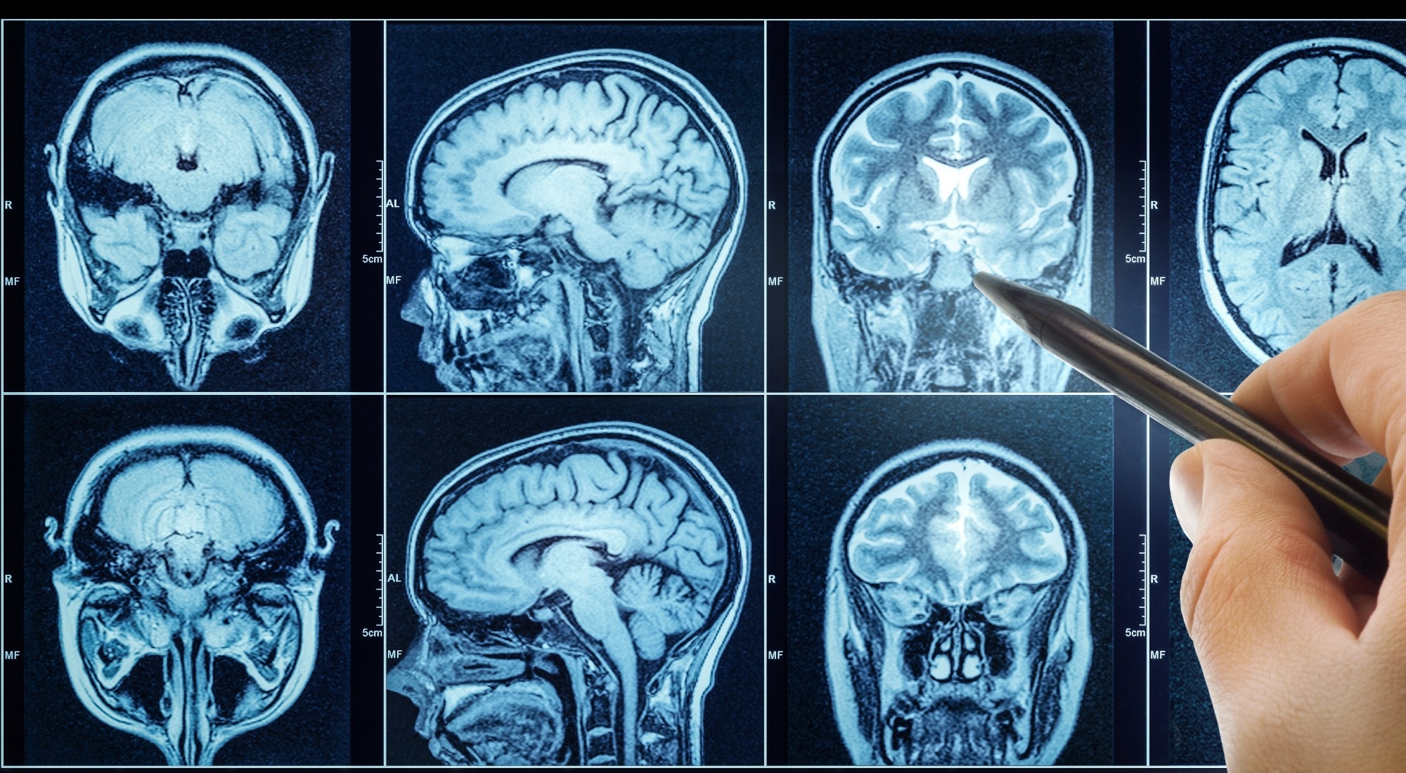 Study: Machine learning-based classification of Alzheimer