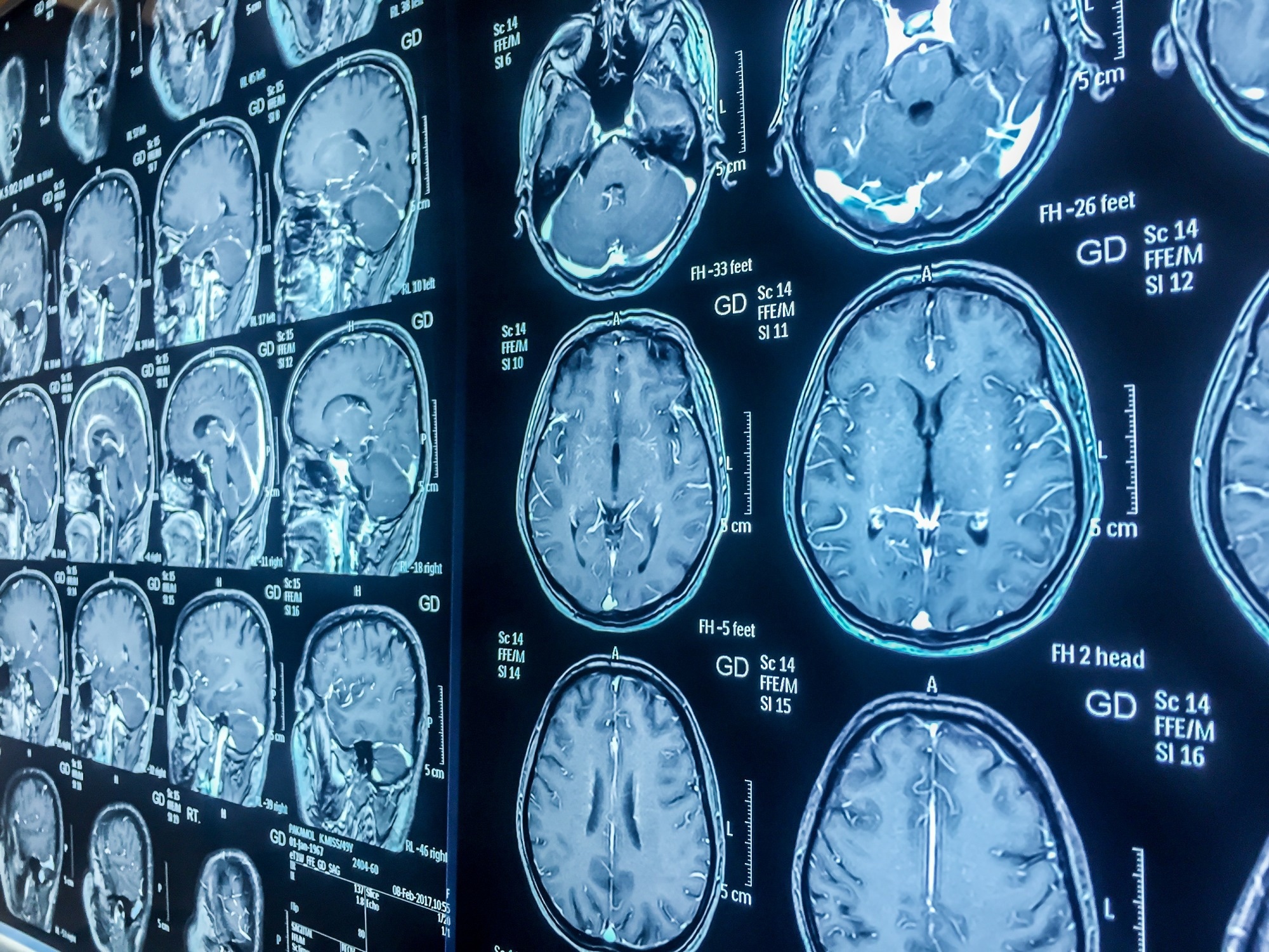 Une étude examine les lésions cérébrales traumatiques pédiatriques en tant que facteur de risque potentiel de troubles ou de symptômes psychotiques