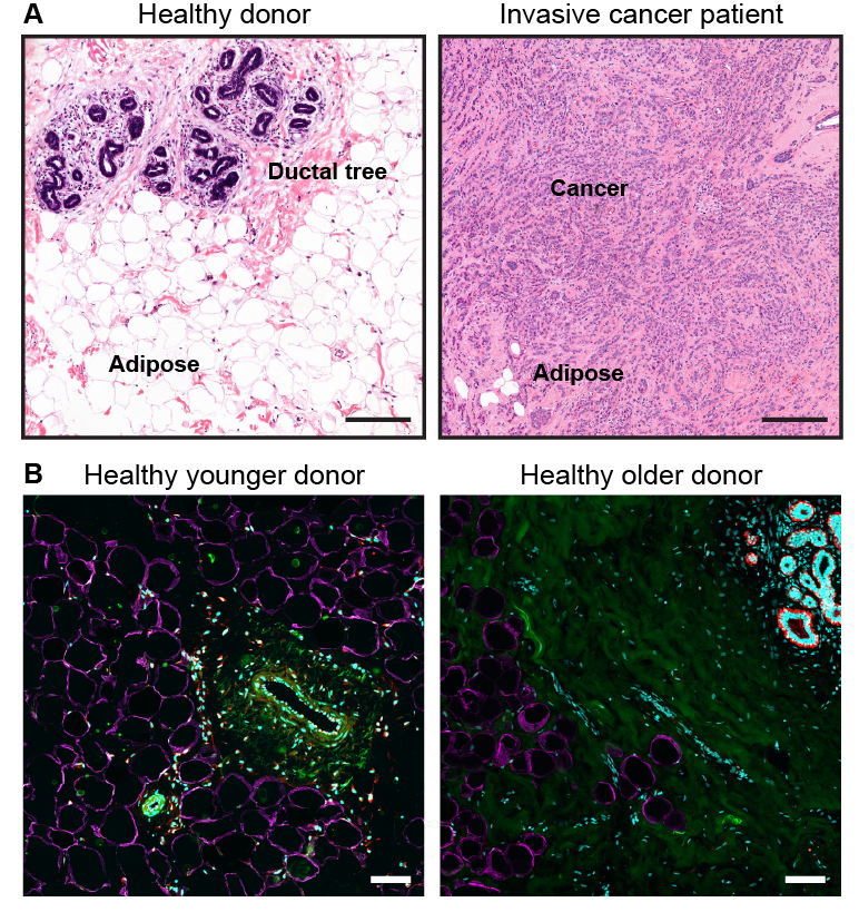 Healthy breast fat may protect against invasive breast cancer
