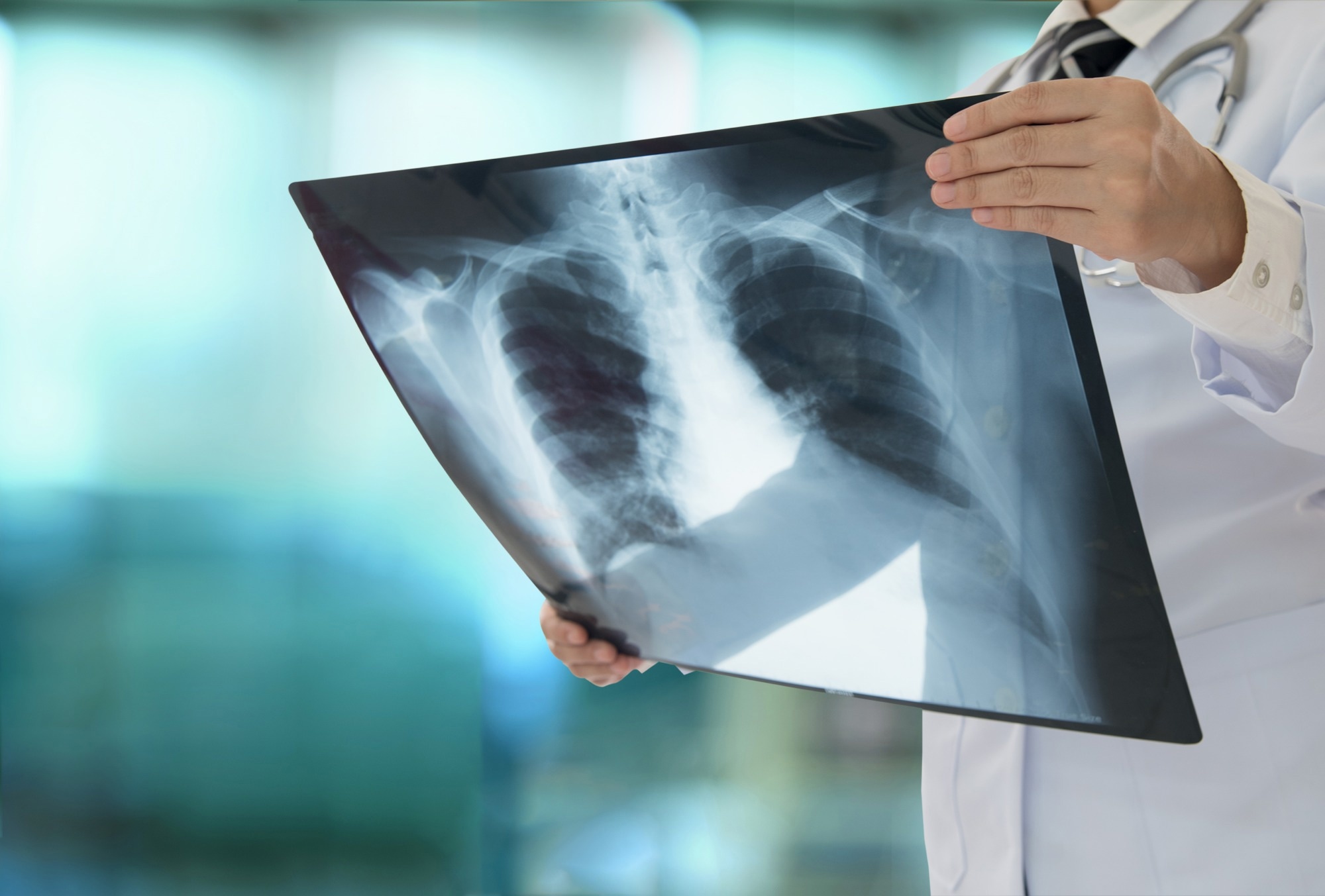 Détection précoce du cancer du poumon avec un modèle d'apprentissage automatique basé sur des biomarqueurs d'imagerie, cliniques et de méthylation de l'ADN