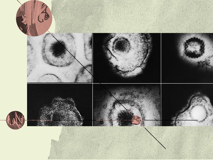 Mélanome : le virus de l'herpès génétiquement modifié peut améliorer le traitement