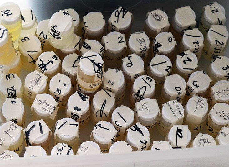 Un test d'urine pourrait-il aider à prédire le risque de première insuffisance cardiaque?