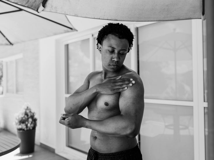 Les personnes atteintes de psoriasis sévère courent un risque plus élevé de maladie cardiaque, selon les chercheurs