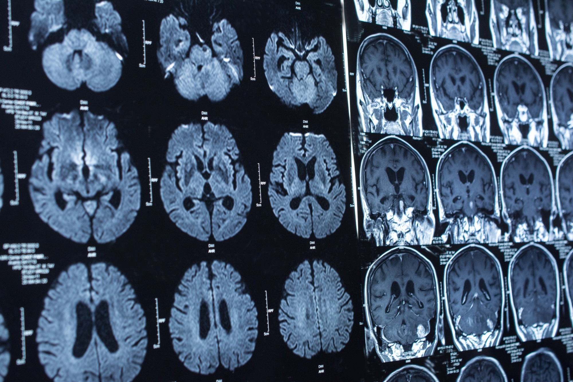 Les plasmalogènes marins pourraient-ils être l’arme secrète pour lutter contre Alzheimer et Parkinson ?