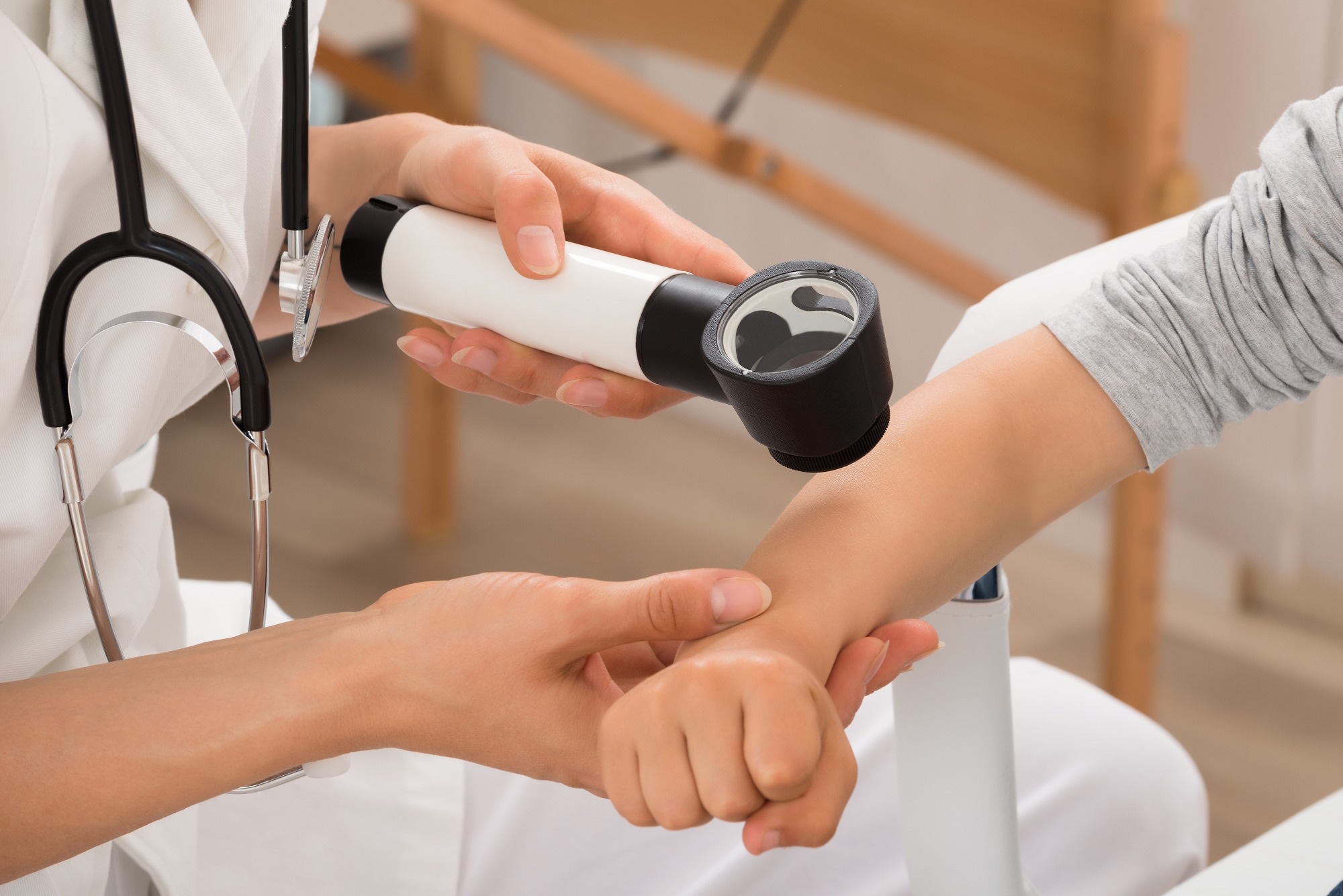 UV-radiation and MC1R germline mutations are risk factors for the development of conventional and spitzoid melanomas in children and adolescents