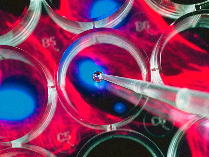 Sclérose en plaques : comment la thérapie par cellules souches pourrait devenir un traitement contre la SEP