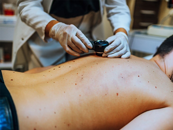 Pourquoi le cancer de la peau autre que le mélanome est désormais plus mortel que le mélanome dans le monde
